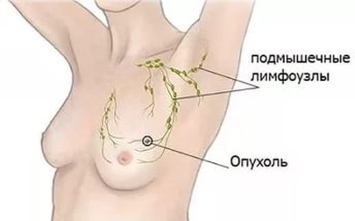 опухоль молочной железы